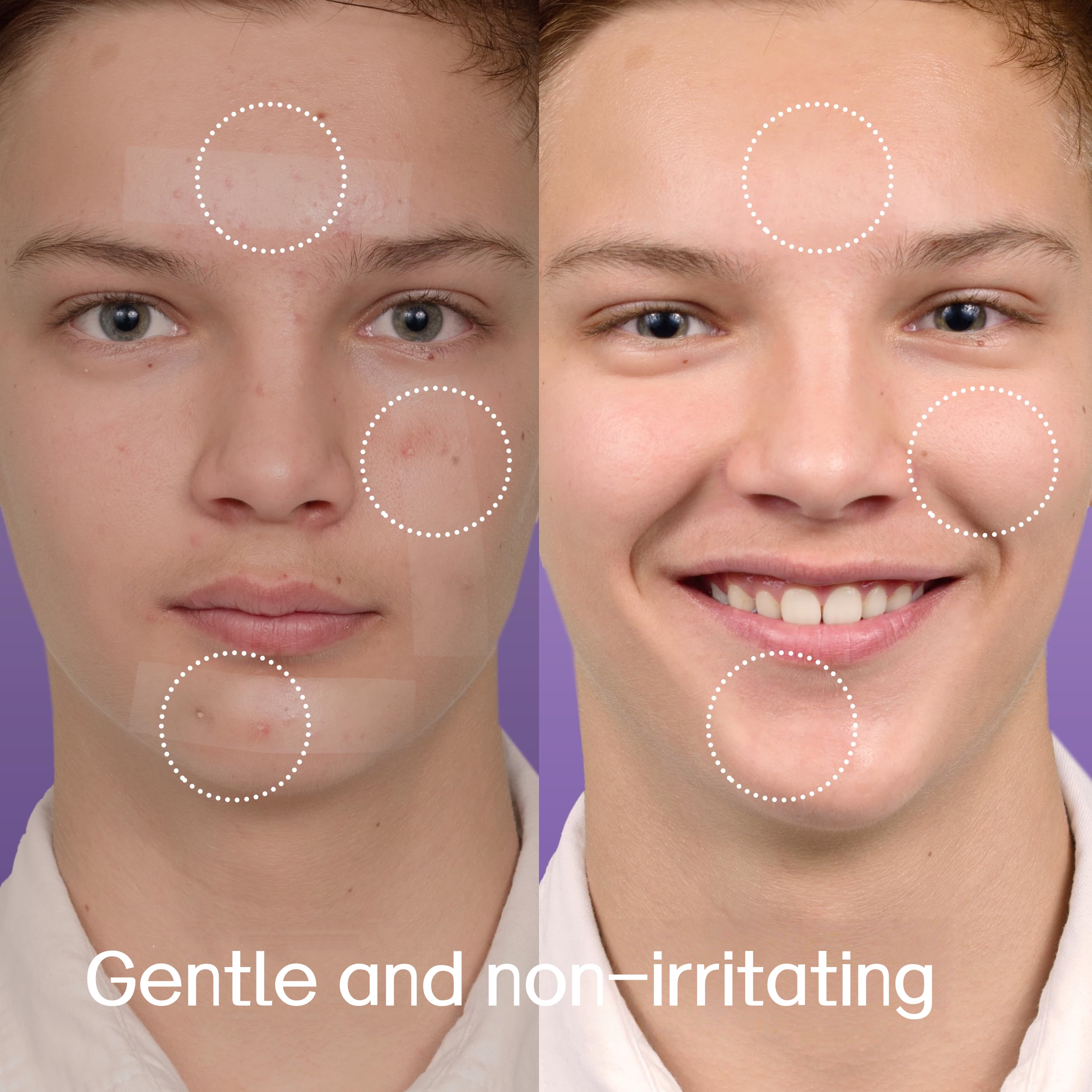 30 XL acne patches, suitable f – Xl Skincare recenzja i cena